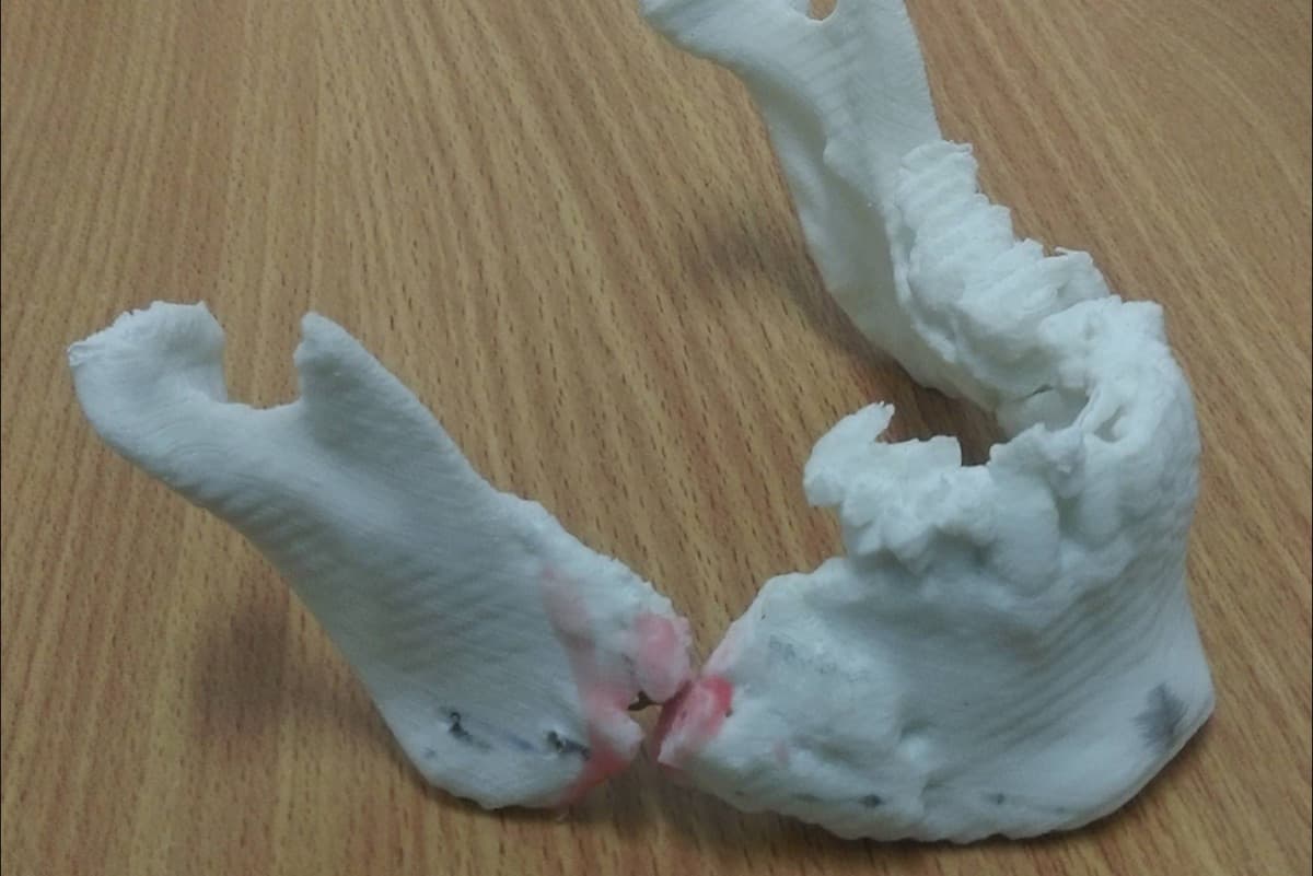 3D printed surgical guide